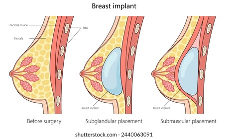 brian vallelunga recommends Grandpa Penile Implant Videos