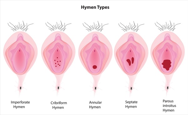 ct ika recommends Defloration Of The Hymen