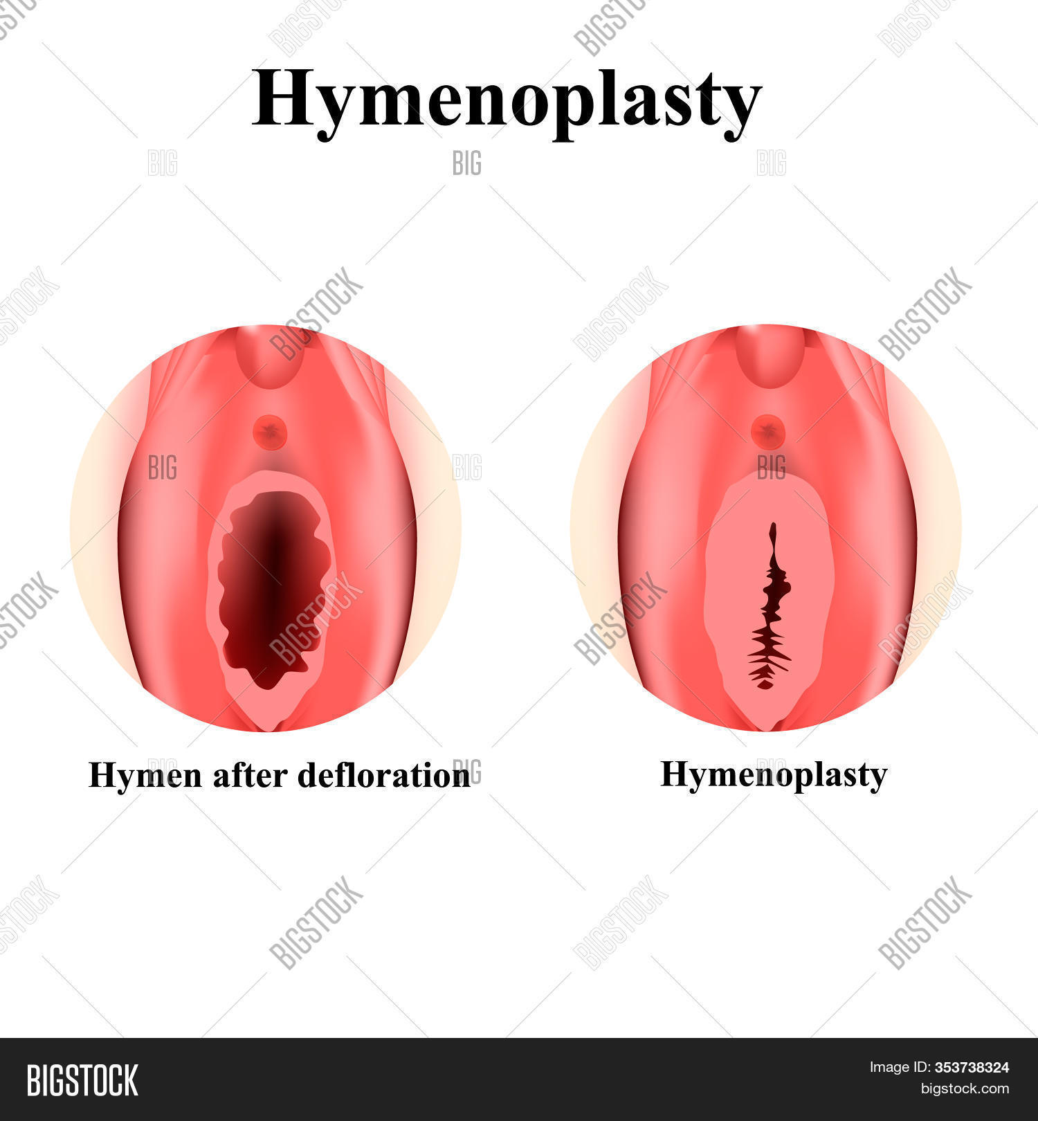 diana moffett recommends defloration of the hymen pic