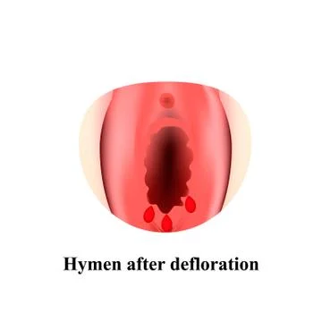 Best of Defloration of the hymen