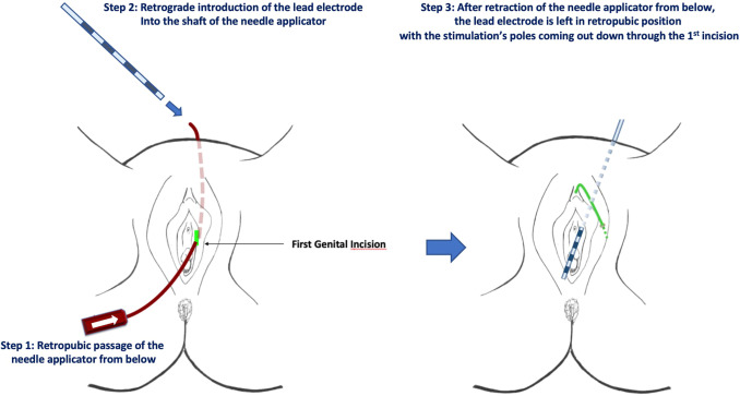 Needle Thru Clit lenee porn